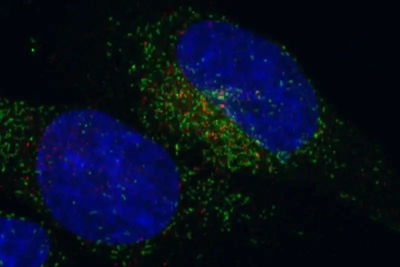 Una cellula tumorale portatrice della fusione genica FGFR3 TACC3