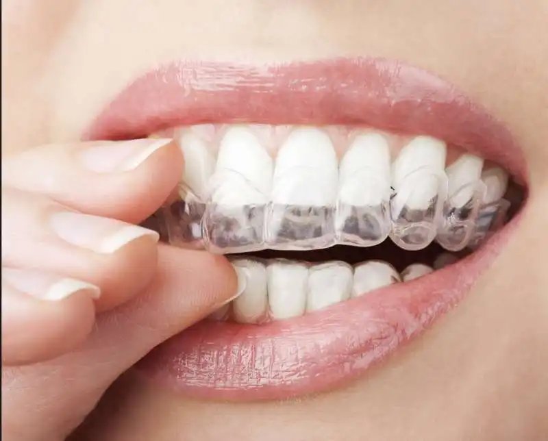 aligner apparecchio invisibile per denti 1