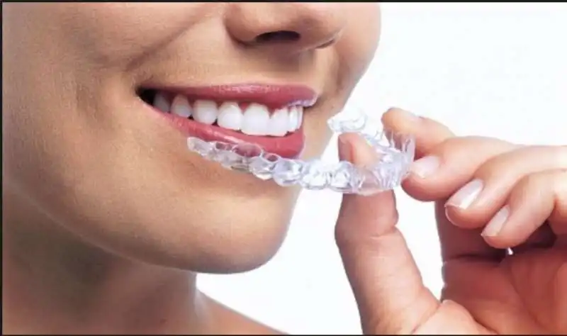 aligner apparecchio invisibile per denti