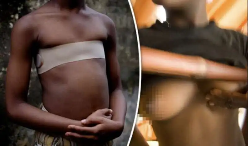 breast ironing   lo stiramento del seno 2