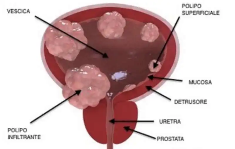 tumore vescica 8