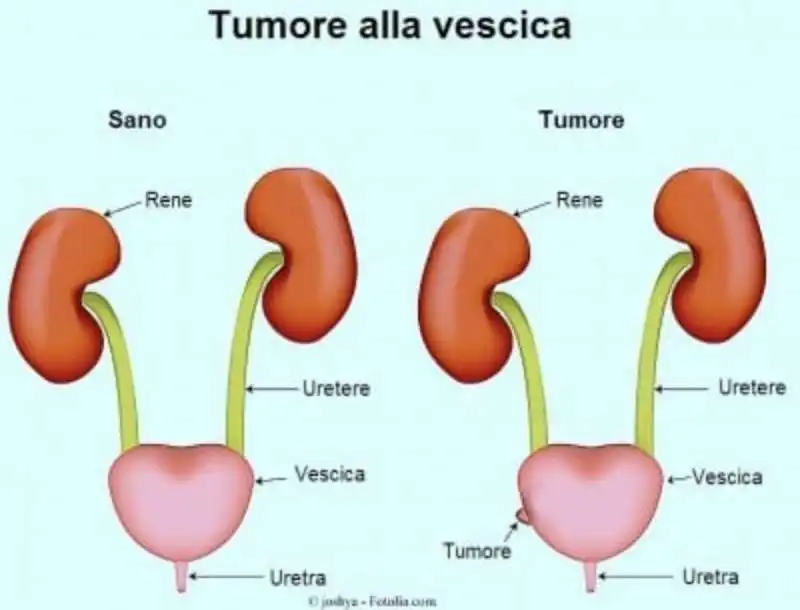 tumore vescica 9