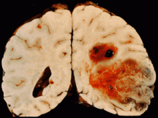 glioma 3