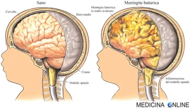 meningite 4