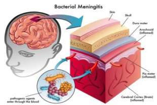 meningite 6