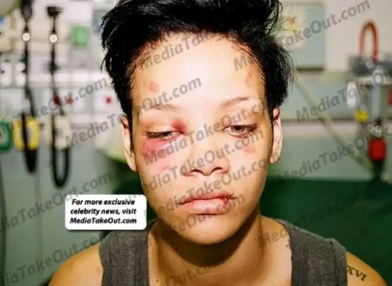 RIHANNA DOPO LAGGRESSIONE DA PARTE DI CHRIS BROWN 