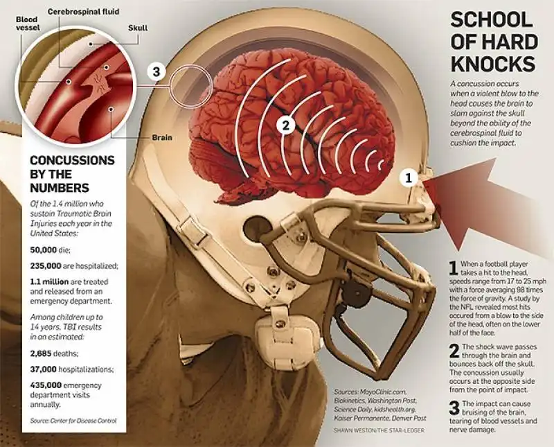 concussions le craniate   nel football americano 