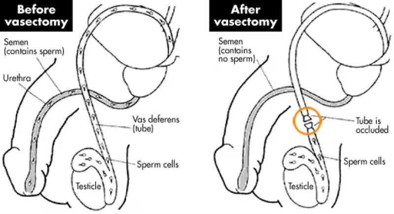 vasectomia