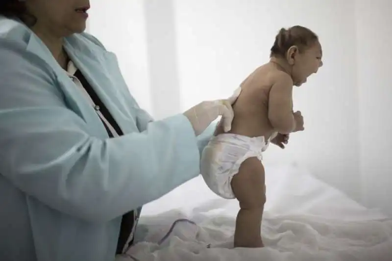 bambina nata con microencefalia causata da zika