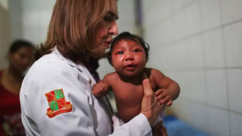 bambina nata  con microencefalia sospetto  zika