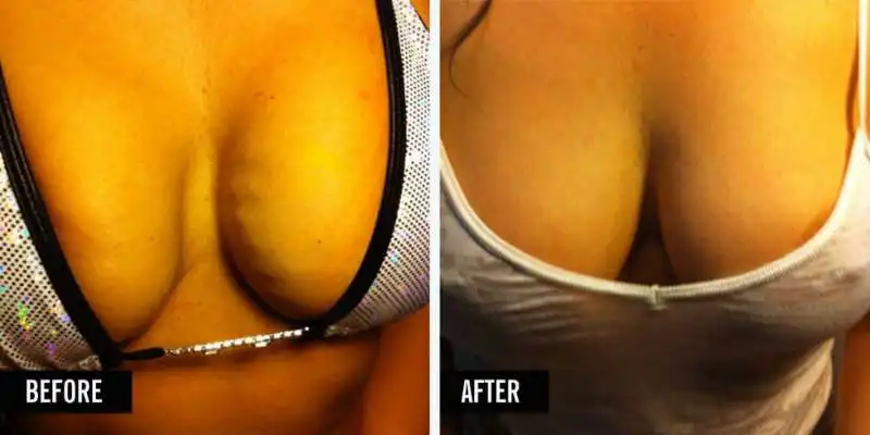 vampire breast lift in regalo agli oscar