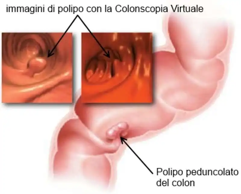 colonscopia colon