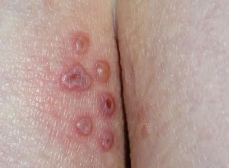 herpes 2