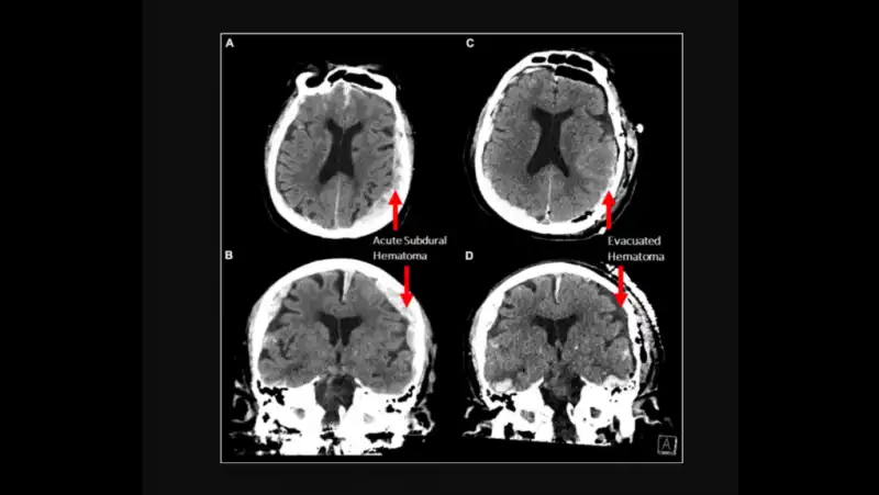 attivita cerebrale prima di morire 