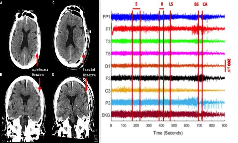 attivita cerebrale prima di morire