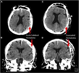 EEG del cervello morente