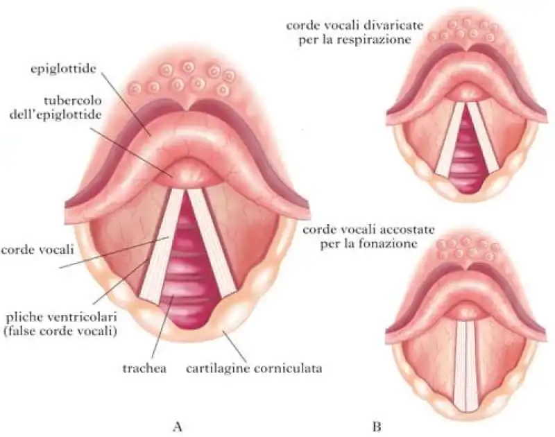 tiroplastica tipo 4 