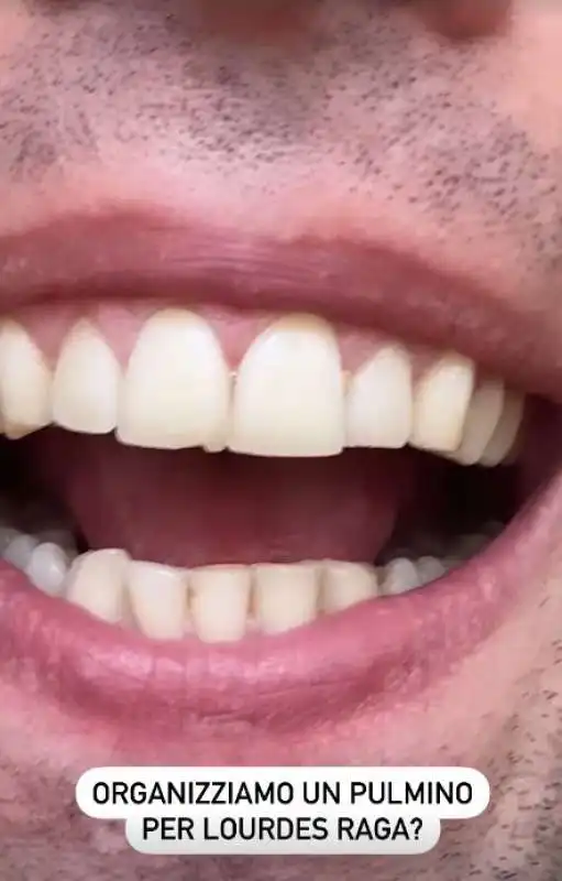 fedez si rompe un dente 1