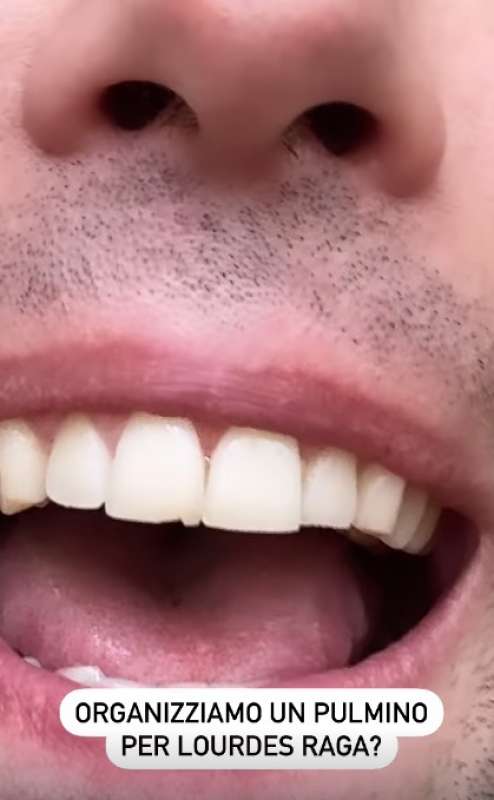 fedez si rompe un dente 4