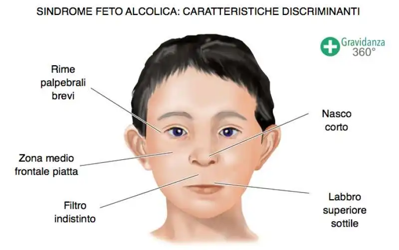 sindrome feto alcolica