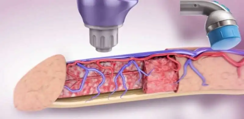 onde urto disfunzione erettile 1