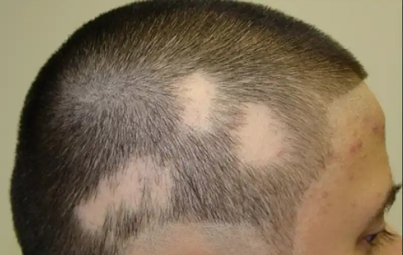 alopecia