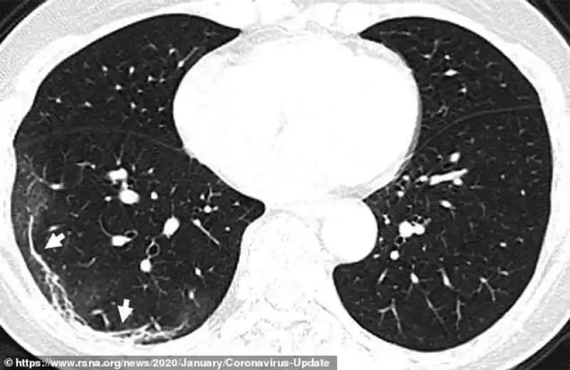 effetti del coronavirus sui polmoni 2