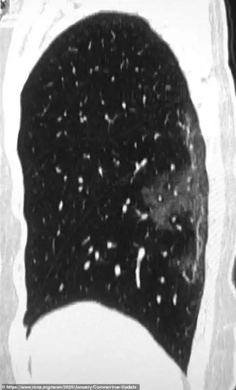 effetti del coronavirus sui polmoni 3