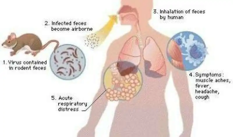 hantavirus 6