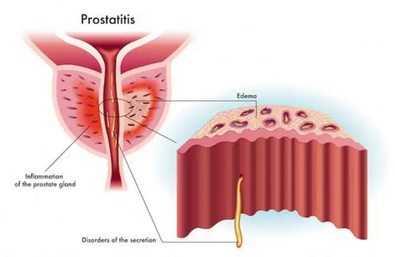 prostatite 10