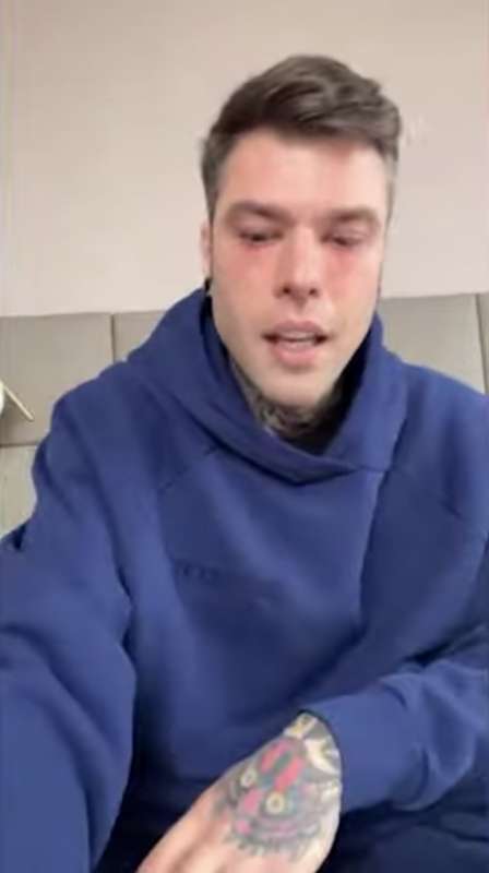 fedez in lacrime racconta di avere una malattia 4