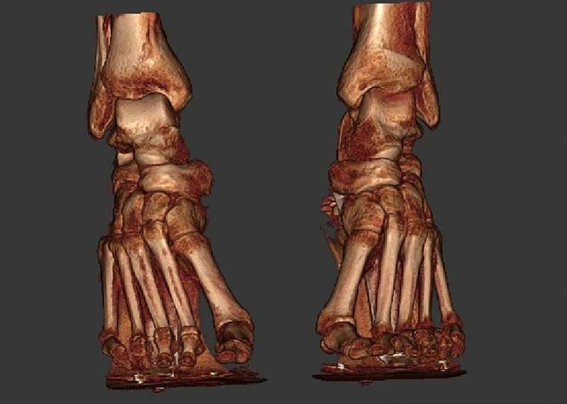 Scansione 3D dei piedi con tacchi alti 2