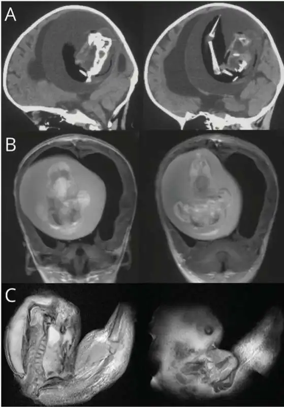 FETO NEL CERVELLO DI BAMBINA CINESE 