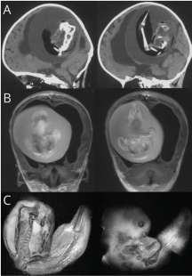 FETO NEL CERVELLO DI BAMBINA CINESE