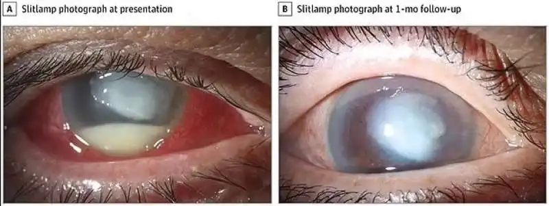 infezione batterica dopo l'uso di lacrime artificiali ezricare e delsam pharma 2 copia