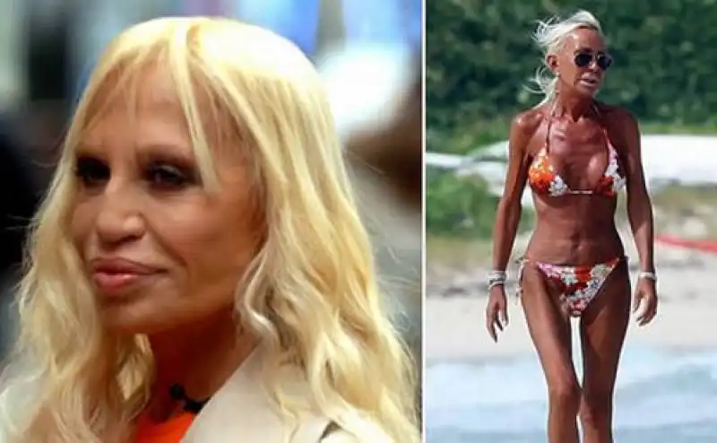 donatella versace plastic surgery disaster