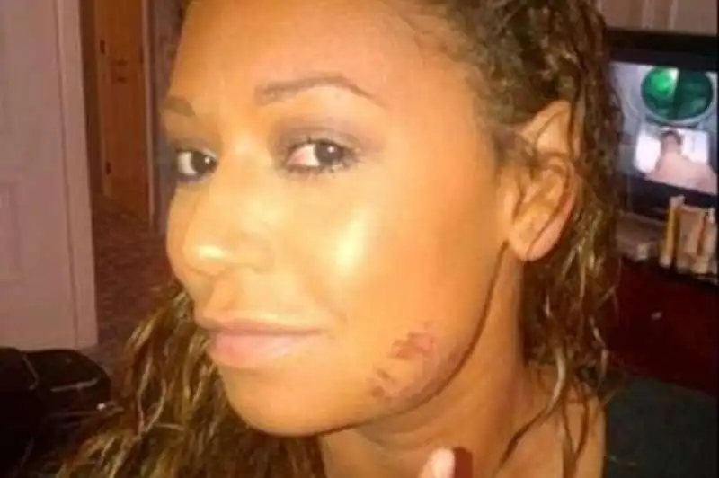 mel b ferita in volto