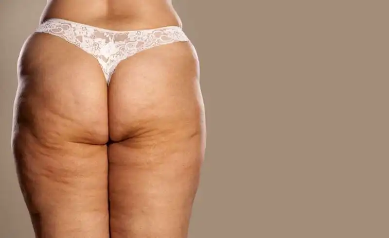 cellulite 1