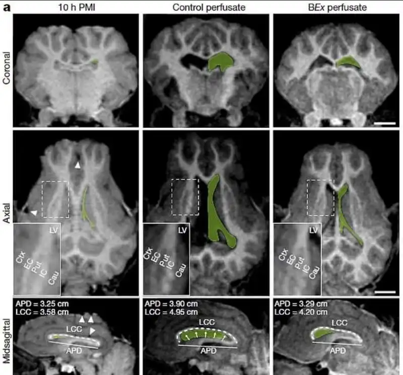 cervello di maiale riattivato dopo 4 ore dalla morte 3