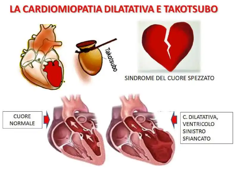 SINDROME DEL CUORE SPEZZATO