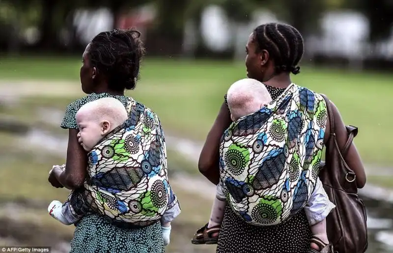 Gli albini in Tanzania sono chiamati Gli invibili 