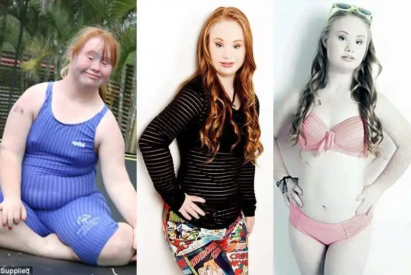 madeline stuart sindrome movil