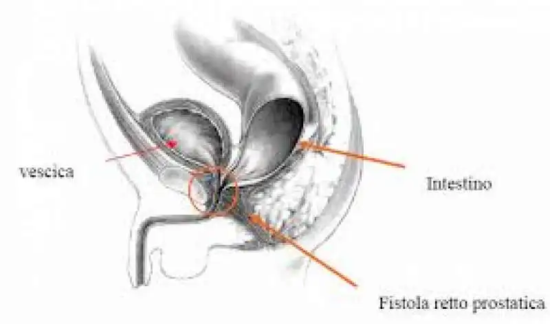 MALFORMAZIONE CLOACA 