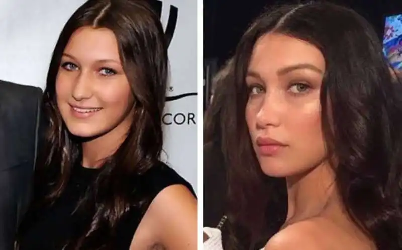 bella hadid prima e dopo il chirurgo