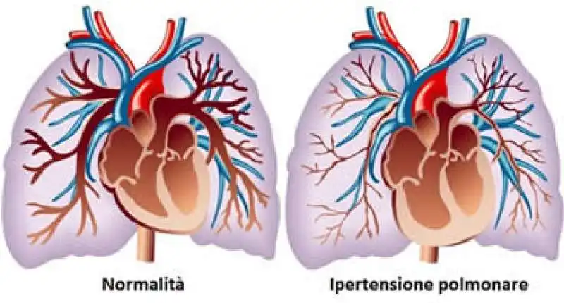 ipertensione-polmonare