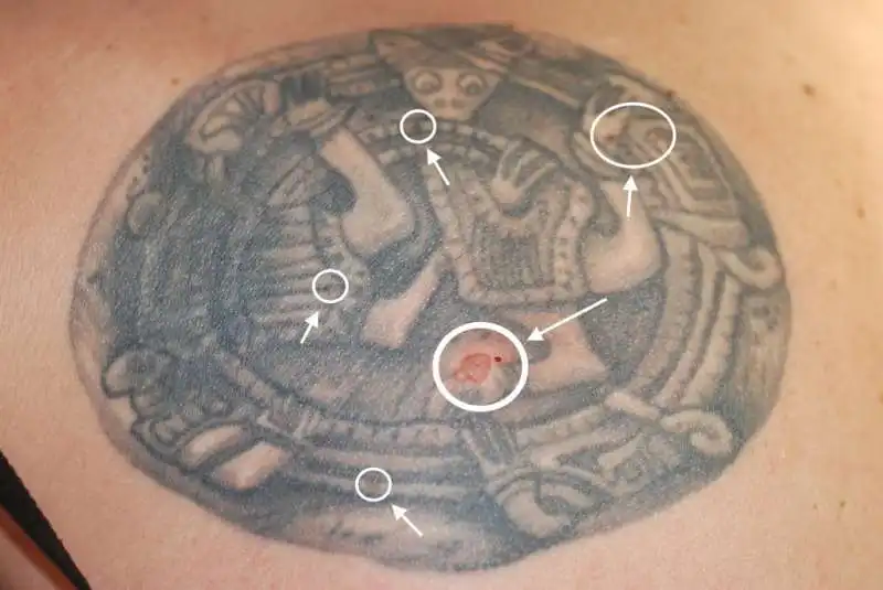 tatuaggi melanoma 1