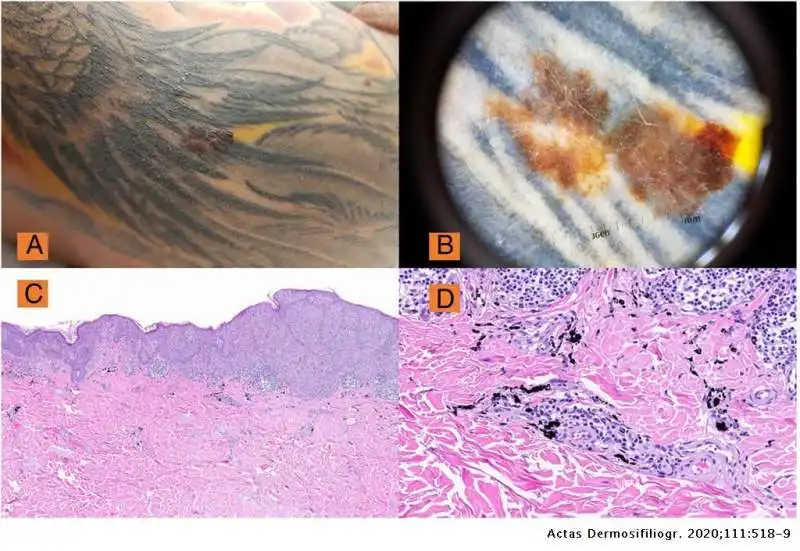 tatuaggi melanoma 2