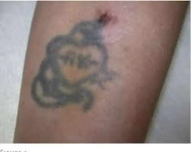 tatuaggi melanoma 7