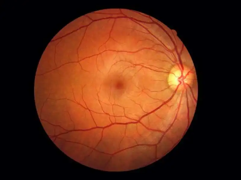 RETINA