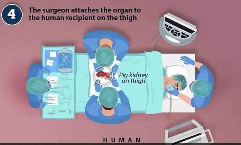 trapianto di rene di maiale   come funziona   1